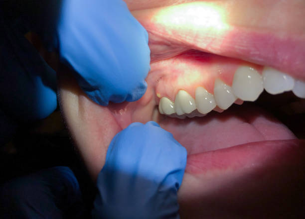 Best Emergency Wisdom Teeth Removal in Chantilly, VA